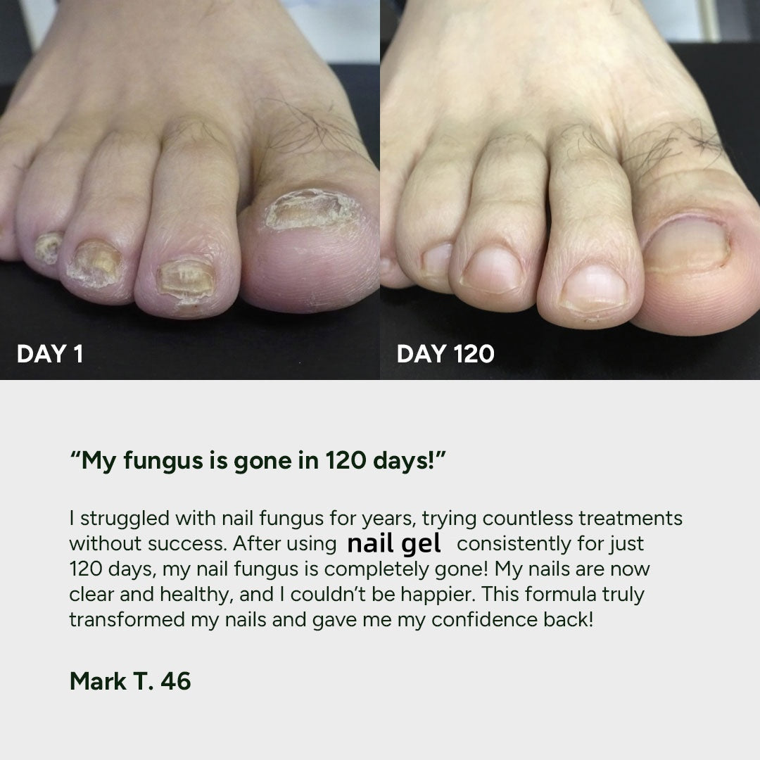 🔥Nail Fungus Treatment Gel