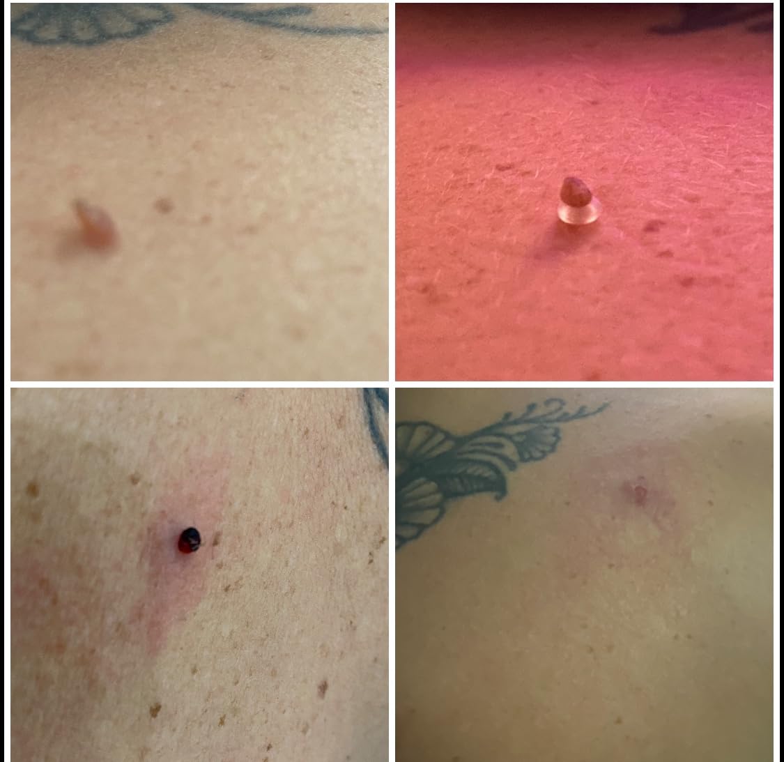 🔥TagBuddy Kit - No More Skin Tags