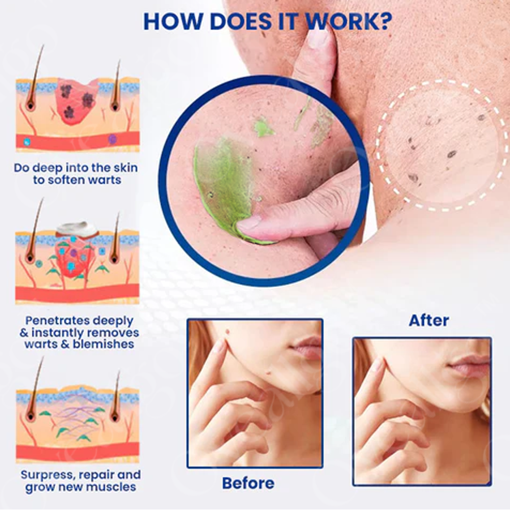 Official Store: NatureErase Instant Mole & Spot Cream