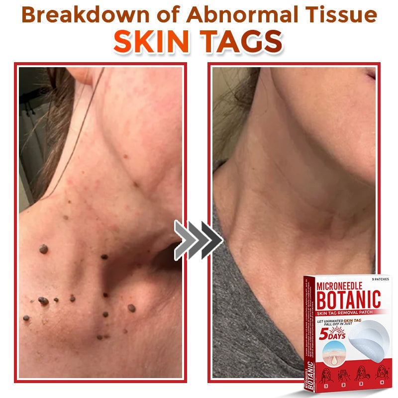 🔥MicroNeedle Botanic Skin Tag Removal Patch 🇺🇸 Made in the USA⏰