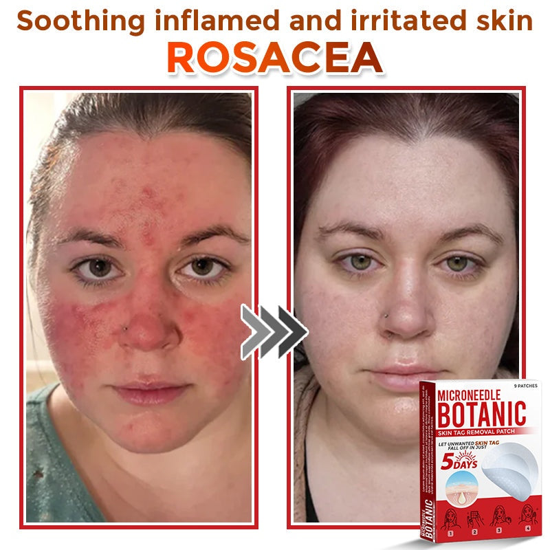 🔥MicroNeedle Botanic Skin Tag Removal Patch 🇺🇸 Made in the USA⏰