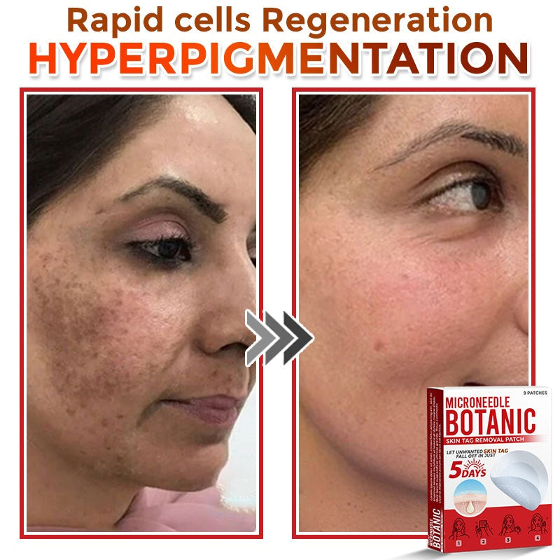 🔥MicroNeedle Botanic Skin Tag Removal Patch 🇺🇸 Made in the USA⏰