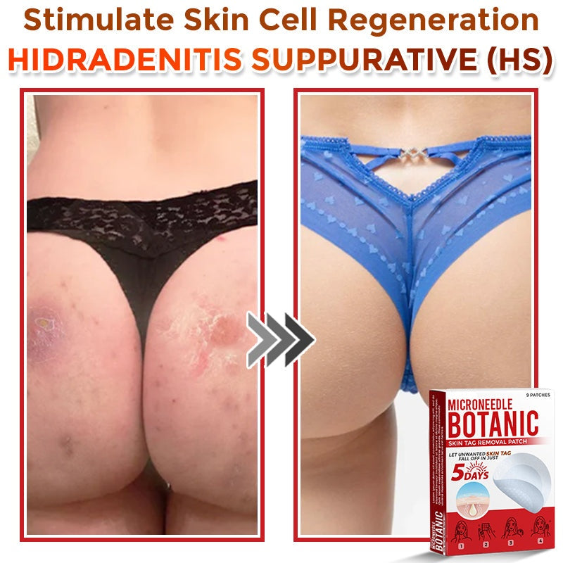 🔥MicroNeedle Botanic Skin Tag Removal Patch 🇺🇸 Made in the USA⏰