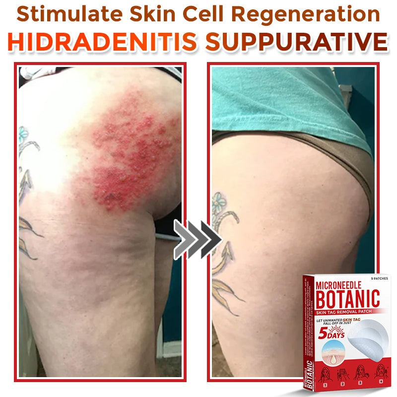 🔥MicroNeedle Botanic Skin Tag Removal Patch 🇺🇸 Made in the USA⏰
