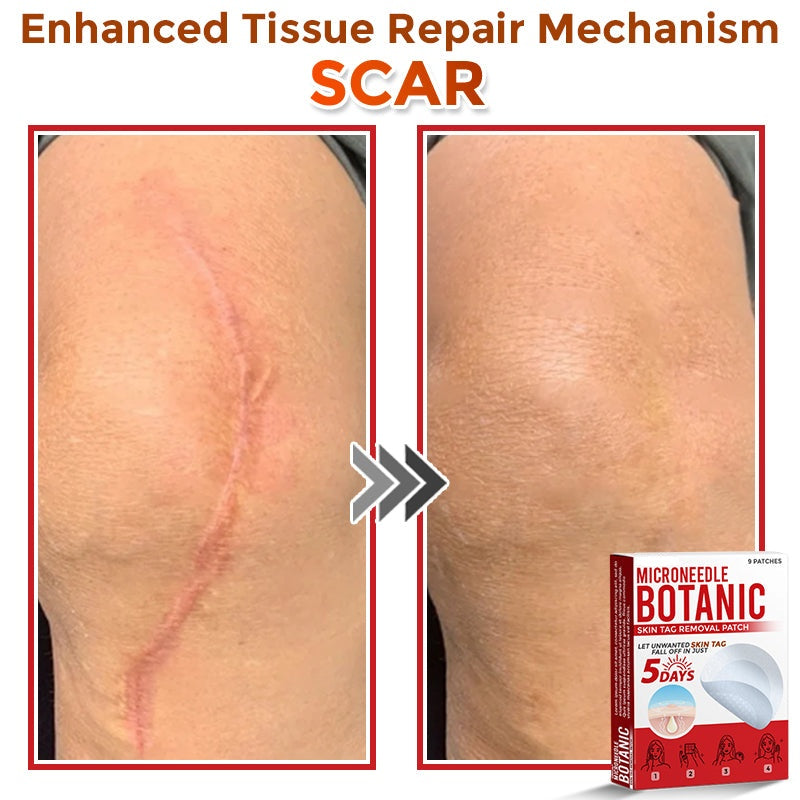 🔥MicroNeedle Botanic Skin Tag Removal Patch 🇺🇸 Made in the USA⏰