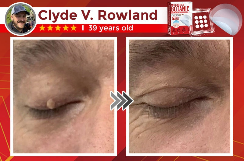 🔥MicroNeedle Botanic Skin Tag Removal Patch 🇺🇸 Made in the USA⏰