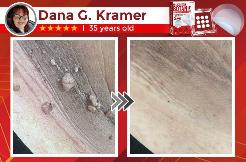 🔥MicroNeedle Botanic Skin Tag Removal Patch 🇺🇸 Made in the USA⏰
