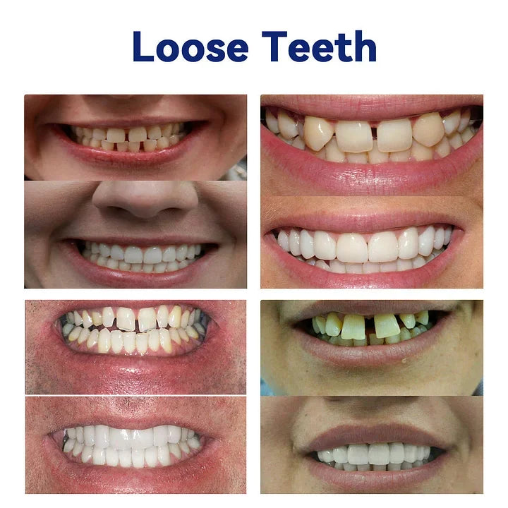 🔥Advanced Customized Full Denture Set