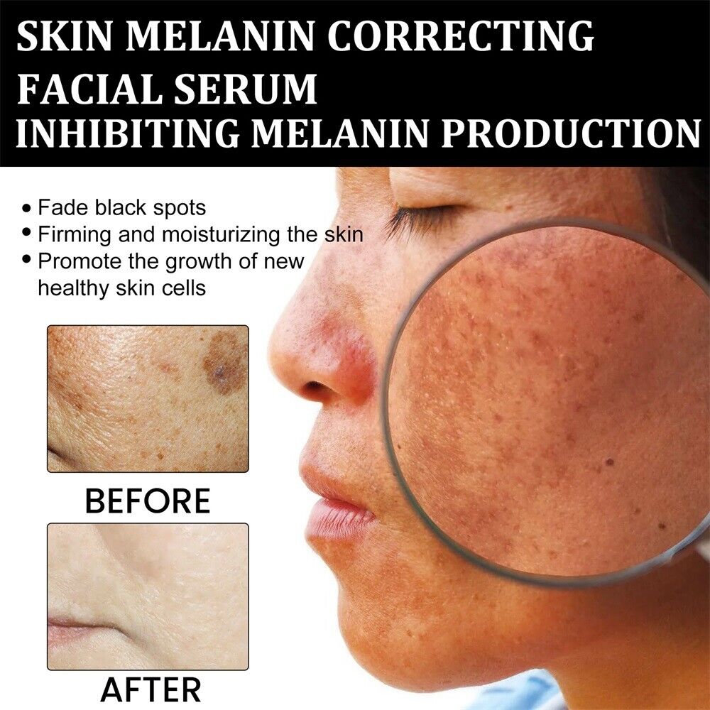 š„Fast Dark Spot Remover-Melanin Correcting Facial Serum