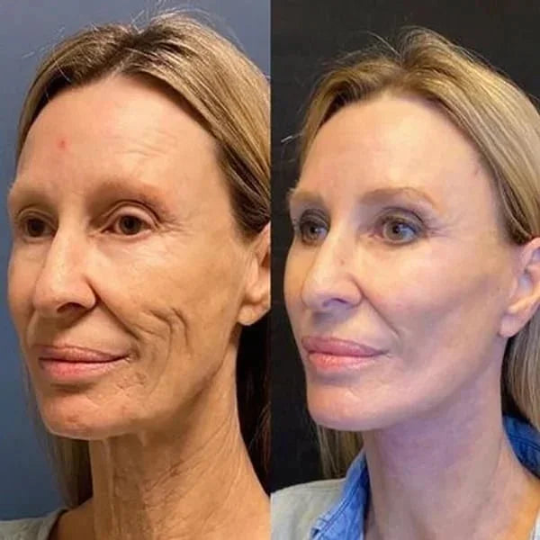 🎉Botox Face Serum🎉