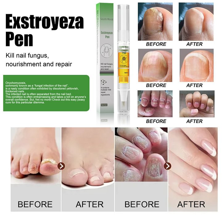 👑Anti-Fungal Pen – Gets Rid Of Even the Most Stubborn Nail Fungus🔥