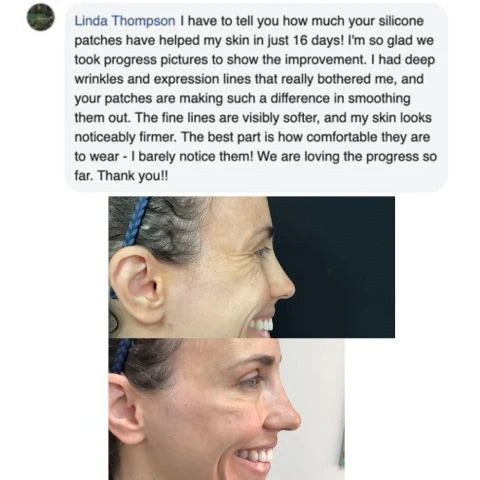 šSilicone Scar Sheets