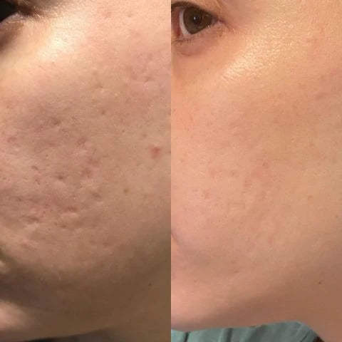 šSilicone Scar Sheets