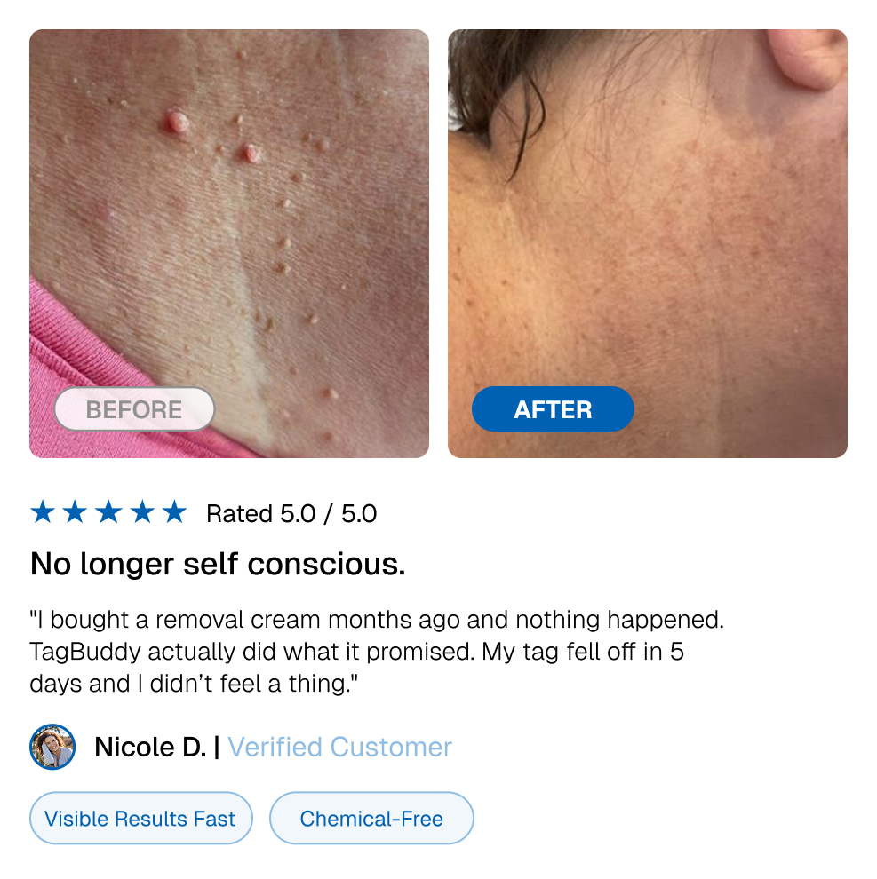 🔥TagBuddy Kit - No More Skin Tags