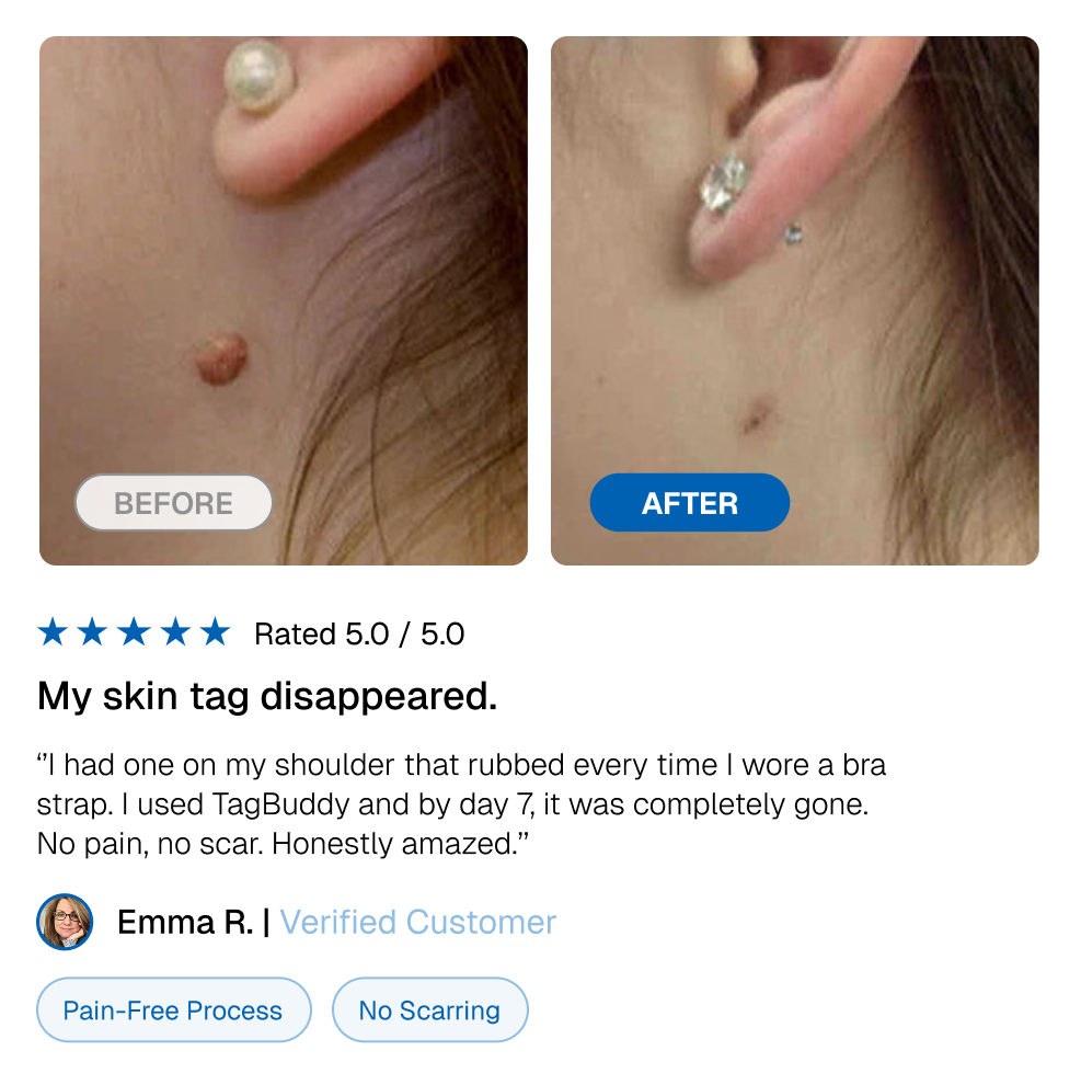 🔥TagBuddy Kit - No More Skin Tags