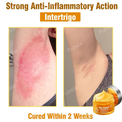 🎉𝑩𝒆𝒆 𝑽𝒆𝒏𝒐𝒎 𝑺𝒌𝒊𝒏 𝑻𝒓𝒆𝒂𝒕𝒎𝒆𝒏𝒕 𝑺𝒆𝒓𝒖𝒎 𝑪𝒓𝒆𝒂𝒎👨‍⚕️ (Suitable for all ages & FDA recommends)