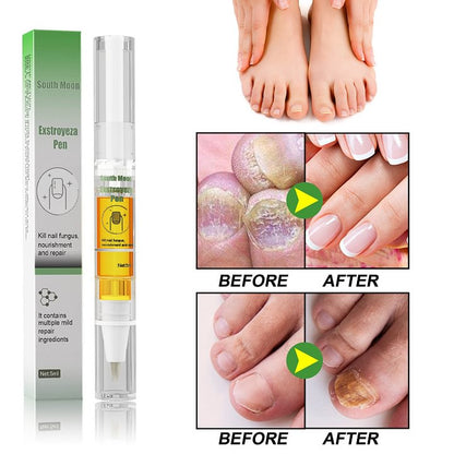 🎁Anti-Fungal Pen – Gets Rid Of Even the Most Stubborn Nail Fungus-51%off