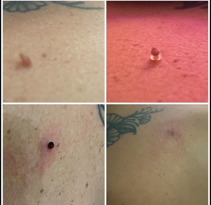 🎁TagBuddy Kit - No More Skin Tags-50%off