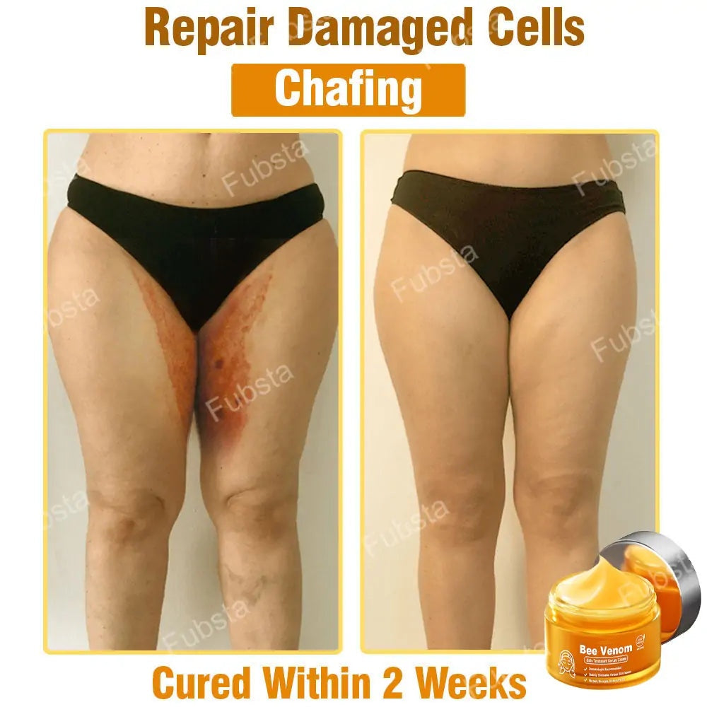 🎉𝑩𝒆𝒆 𝑽𝒆𝒏𝒐𝒎 𝑺𝒌𝒊𝒏 𝑻𝒓𝒆𝒂𝒕𝒎𝒆𝒏𝒕 𝑺𝒆𝒓𝒖𝒎 𝑪𝒓𝒆𝒂𝒎👨‍⚕️ (Suitable for all ages & FDA recommends)