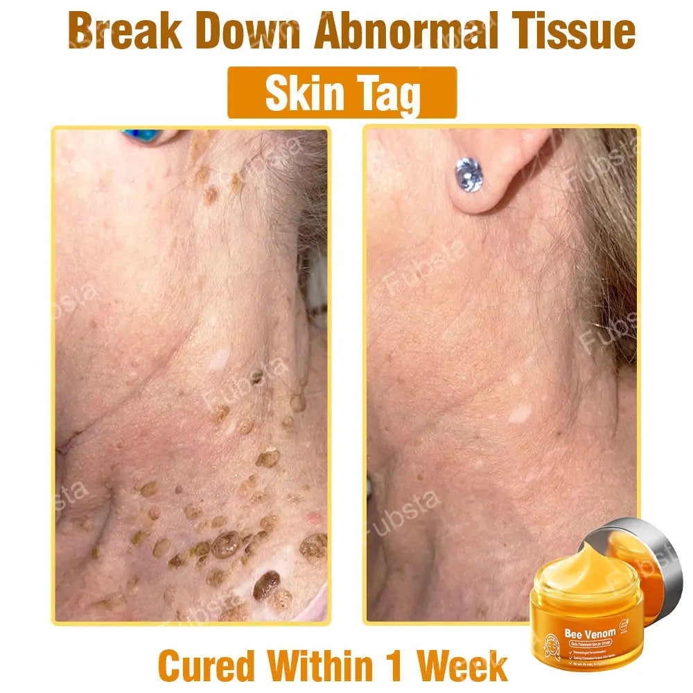 🎉𝑩𝒆𝒆 𝑽𝒆𝒏𝒐𝒎 𝑺𝒌𝒊𝒏 𝑻𝒓𝒆𝒂𝒕𝒎𝒆𝒏𝒕 𝑺𝒆𝒓𝒖𝒎 𝑪𝒓𝒆𝒂𝒎👨‍⚕️ (Suitable for all ages & FDA recommends)
