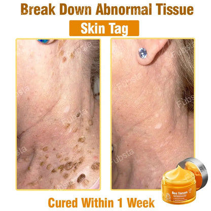 🎉𝑩𝒆𝒆 𝑽𝒆𝒏𝒐𝒎 𝑺𝒌𝒊𝒏 𝑻𝒓𝒆𝒂𝒕𝒎𝒆𝒏𝒕 𝑺𝒆𝒓𝒖𝒎 𝑪𝒓𝒆𝒂𝒎👨‍⚕️ (Suitable for all ages & FDA recommends)