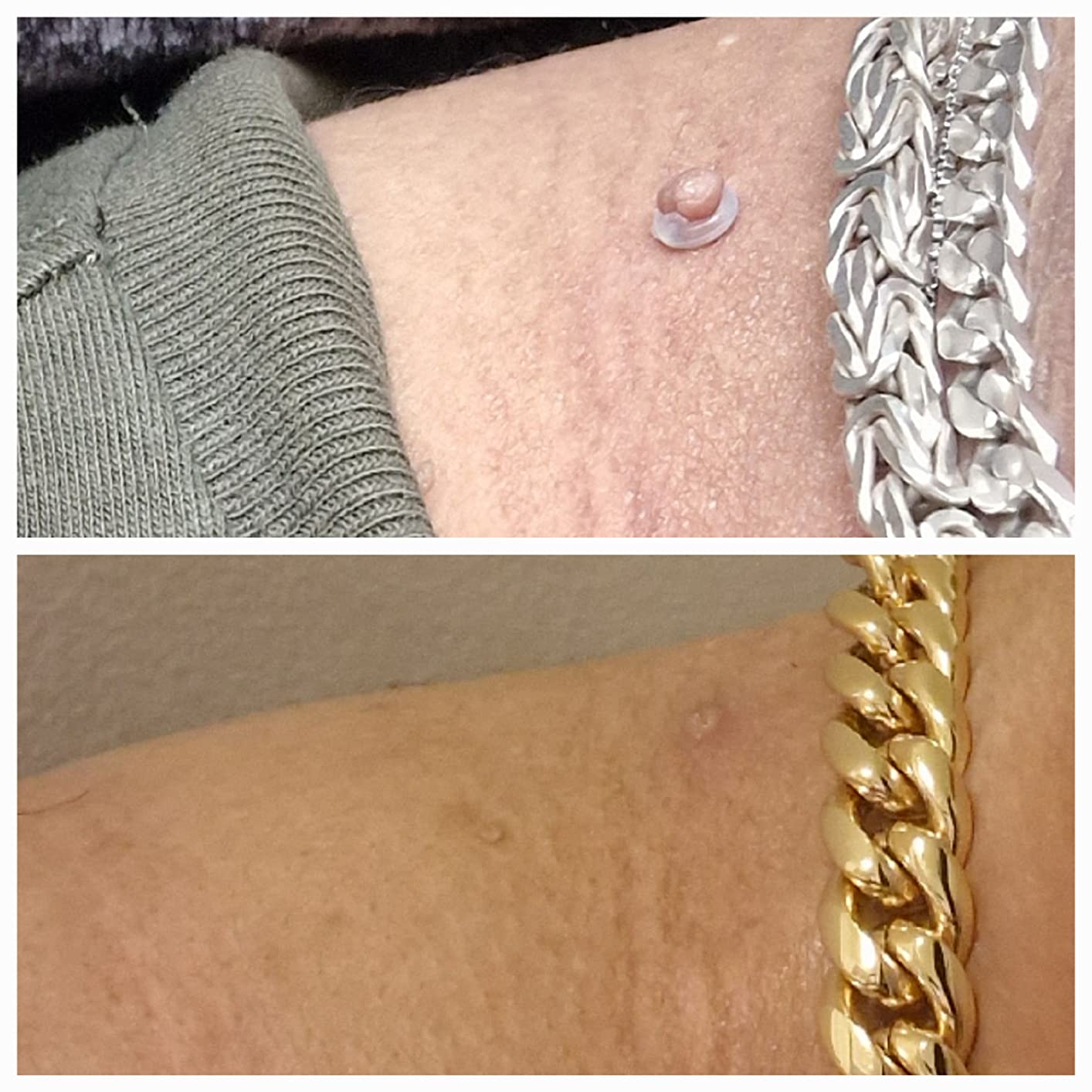 🎁TagBuddy Kit - No More Skin Tags-50%off