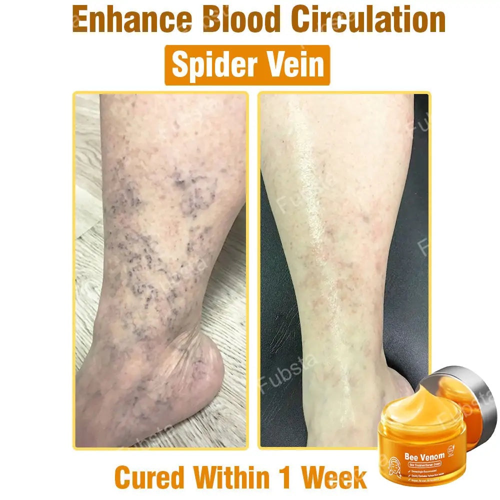 🎉𝑩𝒆𝒆 𝑽𝒆𝒏𝒐𝒎 𝑺𝒌𝒊𝒏 𝑻𝒓𝒆𝒂𝒕𝒎𝒆𝒏𝒕 𝑺𝒆𝒓𝒖𝒎 𝑪𝒓𝒆𝒂𝒎👨‍⚕️ (Suitable for all ages & FDA recommends)