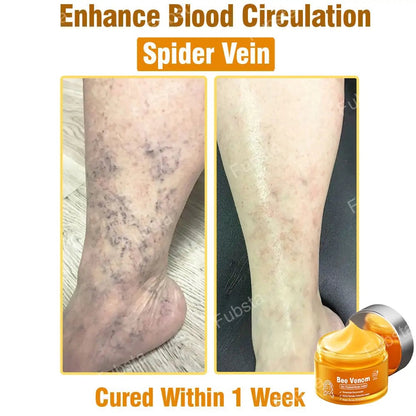 🎉𝑩𝒆𝒆 𝑽𝒆𝒏𝒐𝒎 𝑺𝒌𝒊𝒏 𝑻𝒓𝒆𝒂𝒕𝒎𝒆𝒏𝒕 𝑺𝒆𝒓𝒖𝒎 𝑪𝒓𝒆𝒂𝒎👨‍⚕️ (Suitable for all ages & FDA recommends)