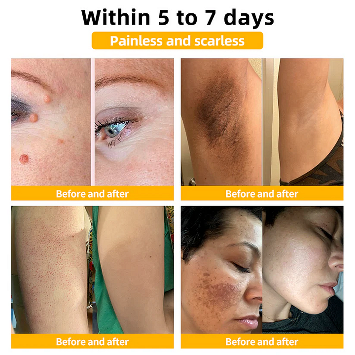 🎈Bee Venom Skin Treatment Cream（✅DERMATOLOGIST RECOMMENDED）