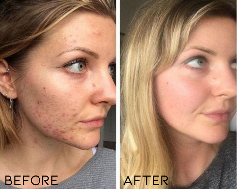 ⏰Limited Offer -Removing Scars, Scars And Lumps