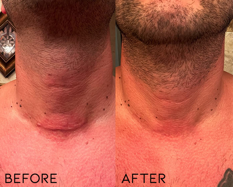 ⏰Limited Offer -Removing Scars, Scars And Lumps