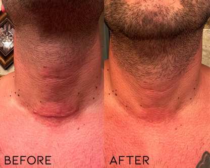 ⏰Limited Offer -Removing Scars, Scars And Lumps