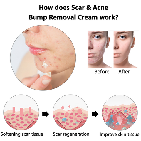 ⏰Limited Offer -Removing Scars, Scars And Lumps