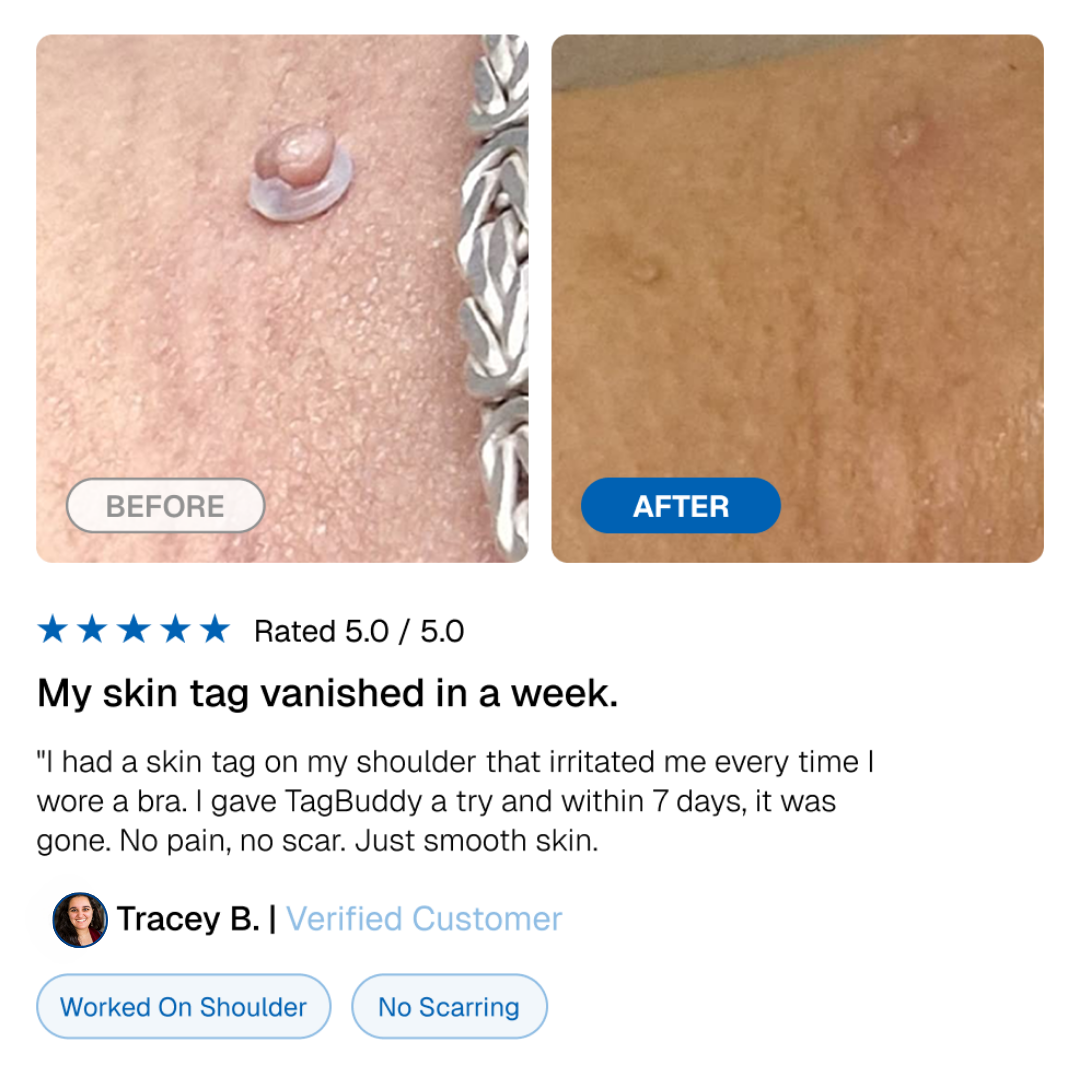 🎁TagBuddy Kit - No More Skin Tags-50%off
