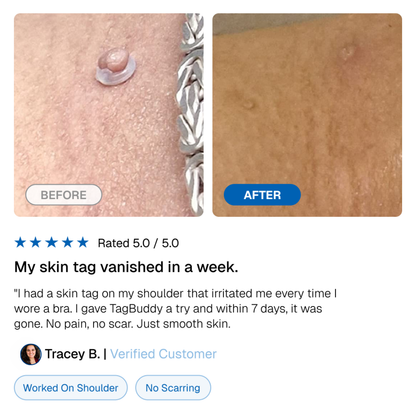 🎁TagBuddy Kit - No More Skin Tags-50%off