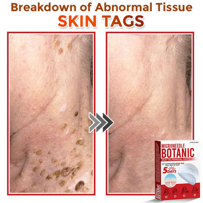 🔥MicroNeedle Botanic Skin Tag Removal Patch 🇺🇸 Made in the USA⏰