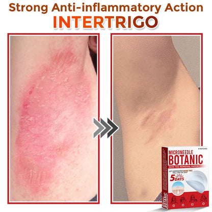 🔥MicroNeedle Botanic Skin Tag Removal Patch 🇺🇸 Made in the USA⏰