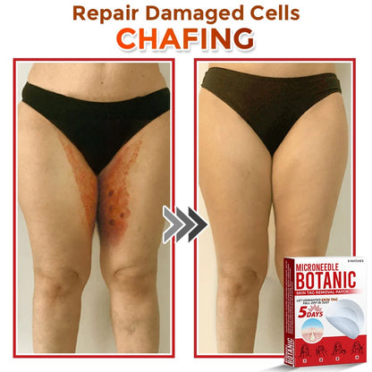 🔥MicroNeedle Botanic Skin Tag Removal Patch 🇺🇸 Made in the USA⏰