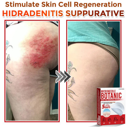🔥MicroNeedle Botanic Skin Tag Removal Patch 🇺🇸 Made in the USA⏰