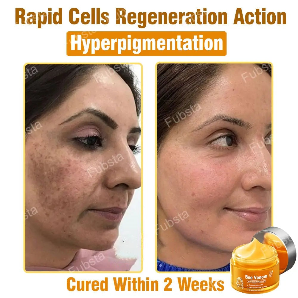 🎉𝑩𝒆𝒆 𝑽𝒆𝒏𝒐𝒎 𝑺𝒌𝒊𝒏 𝑻𝒓𝒆𝒂𝒕𝒎𝒆𝒏𝒕 𝑺𝒆𝒓𝒖𝒎 𝑪𝒓𝒆𝒂𝒎👨‍⚕️ (Suitable for all ages & FDA recommends)