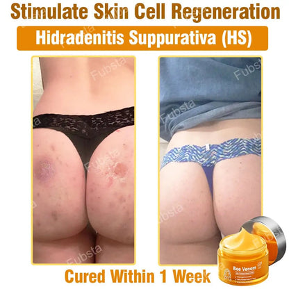 🎉𝑩𝒆𝒆 𝑽𝒆𝒏𝒐𝒎 𝑺𝒌𝒊𝒏 𝑻𝒓𝒆𝒂𝒕𝒎𝒆𝒏𝒕 𝑺𝒆𝒓𝒖𝒎 𝑪𝒓𝒆𝒂𝒎👨‍⚕️ (Suitable for all ages & FDA recommends)