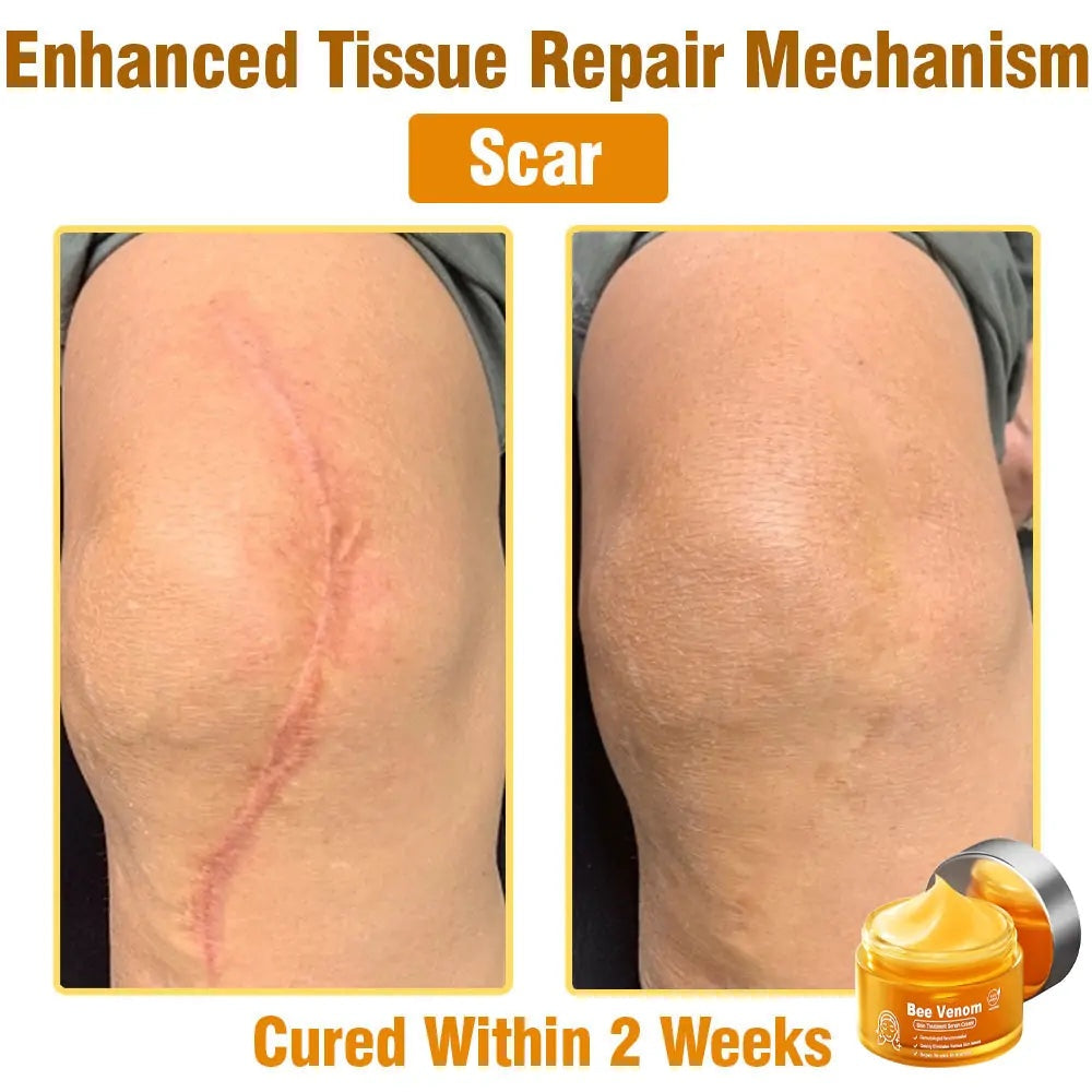 🎉𝑩𝒆𝒆 𝑽𝒆𝒏𝒐𝒎 𝑺𝒌𝒊𝒏 𝑻𝒓𝒆𝒂𝒕𝒎𝒆𝒏𝒕 𝑺𝒆𝒓𝒖𝒎 𝑪𝒓𝒆𝒂𝒎👨‍⚕️ (Suitable for all ages & FDA recommends)