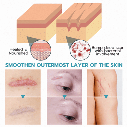 🎁Silicone Scar Sheets